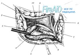     McVay ( Cooper ligament repair ).